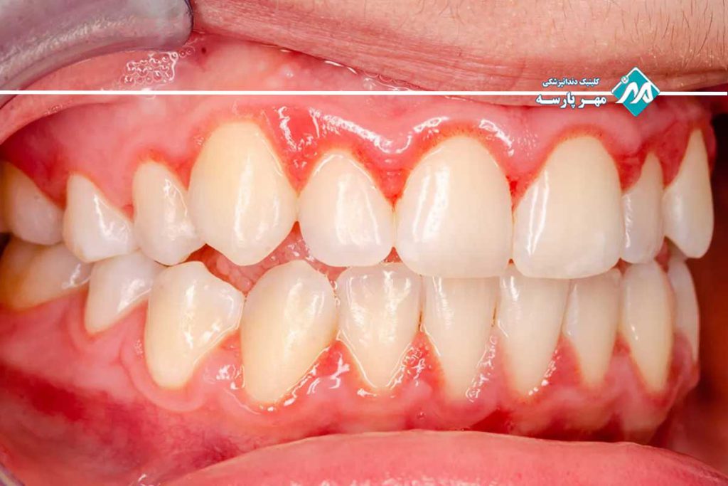 پریودنتیت پیشرفته