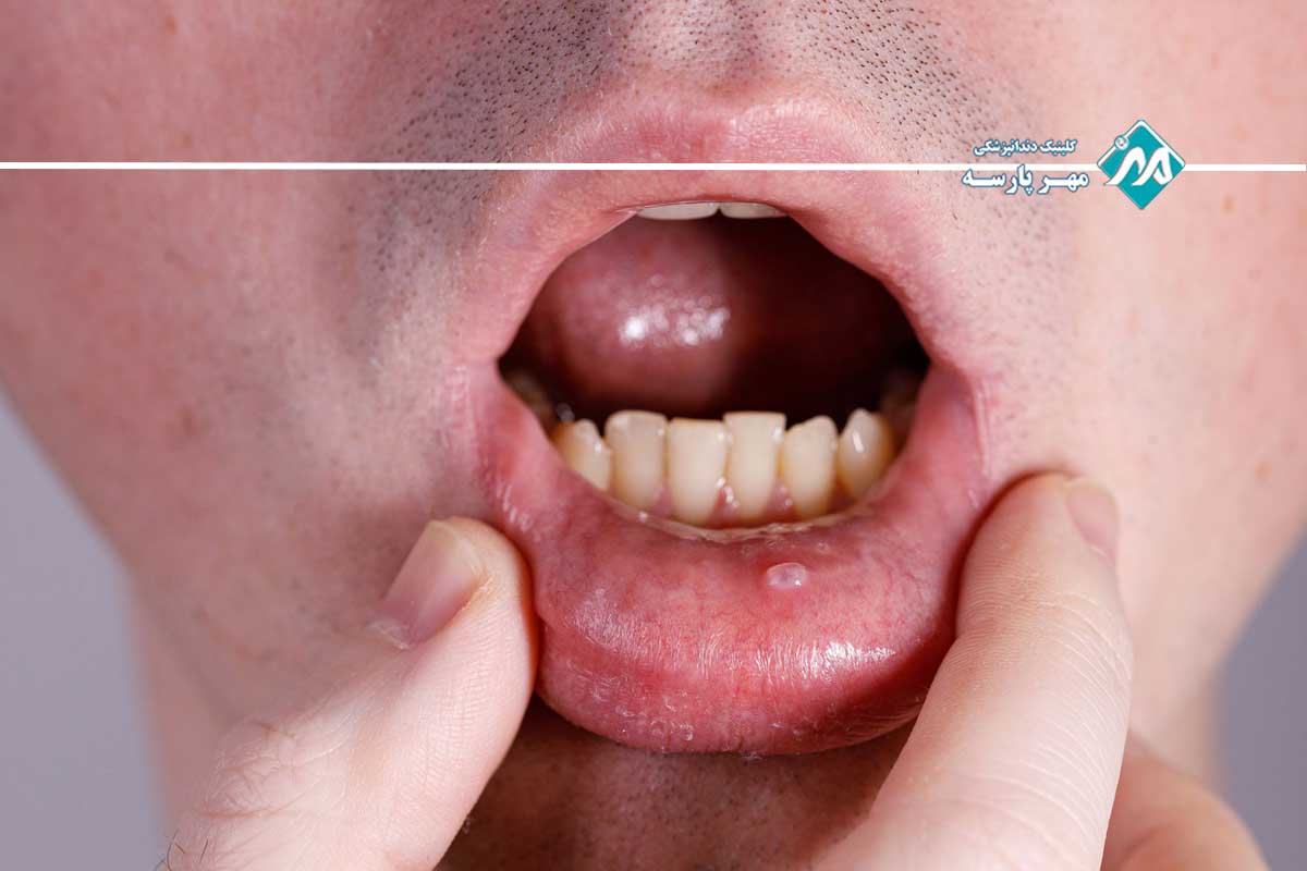 مقایسه انواع موکوسل