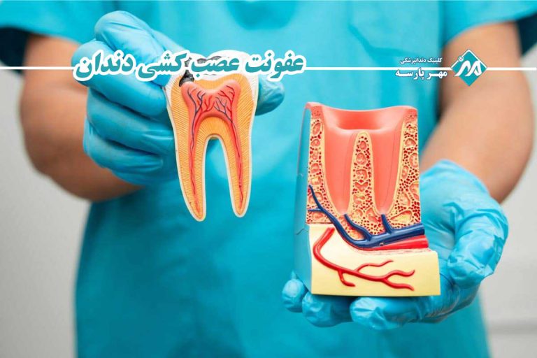 عفونت عصب کشی دندان