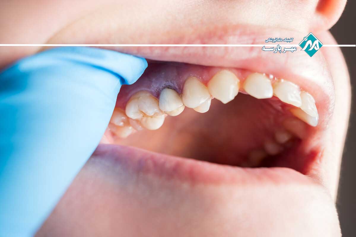 عفونت پس از عصب‌کشی دندان