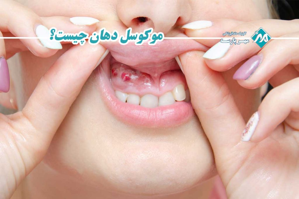 موکوسل دهان