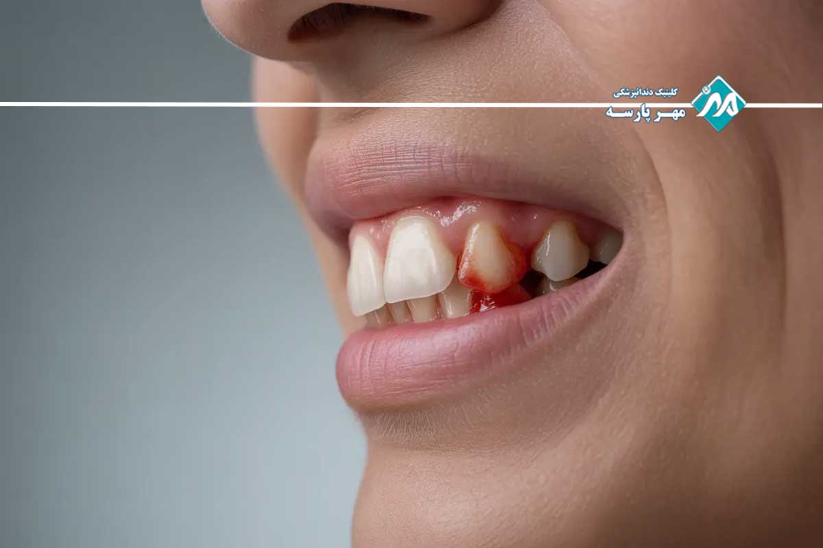 علائم التهاب لثه در بارداری