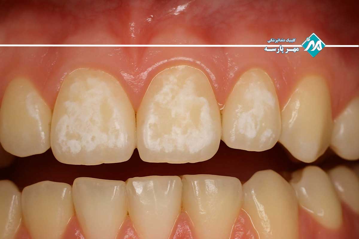 فرسایش مینا دندان توسط اسید معده