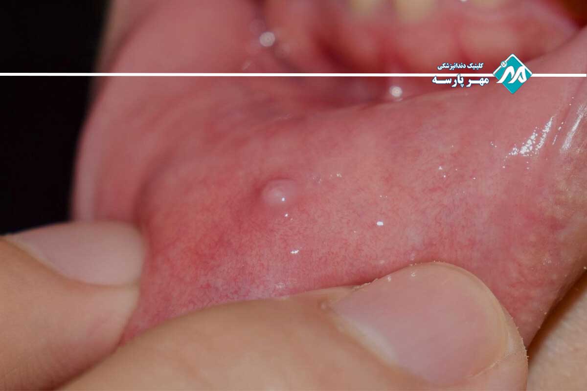 روش‌های درمان موکوسل دهان