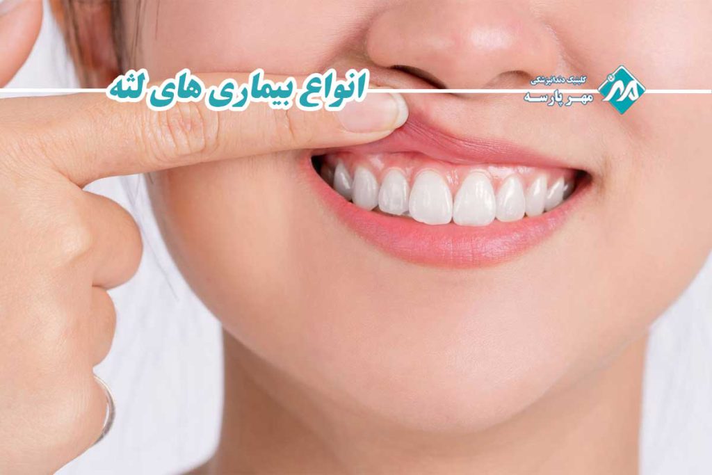 انواع بیماری های لثه