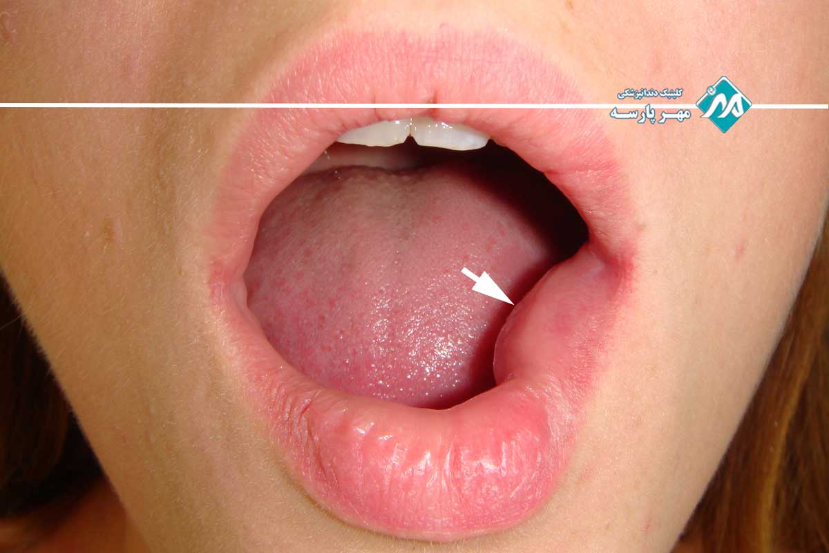 انواع موکوسل دهان