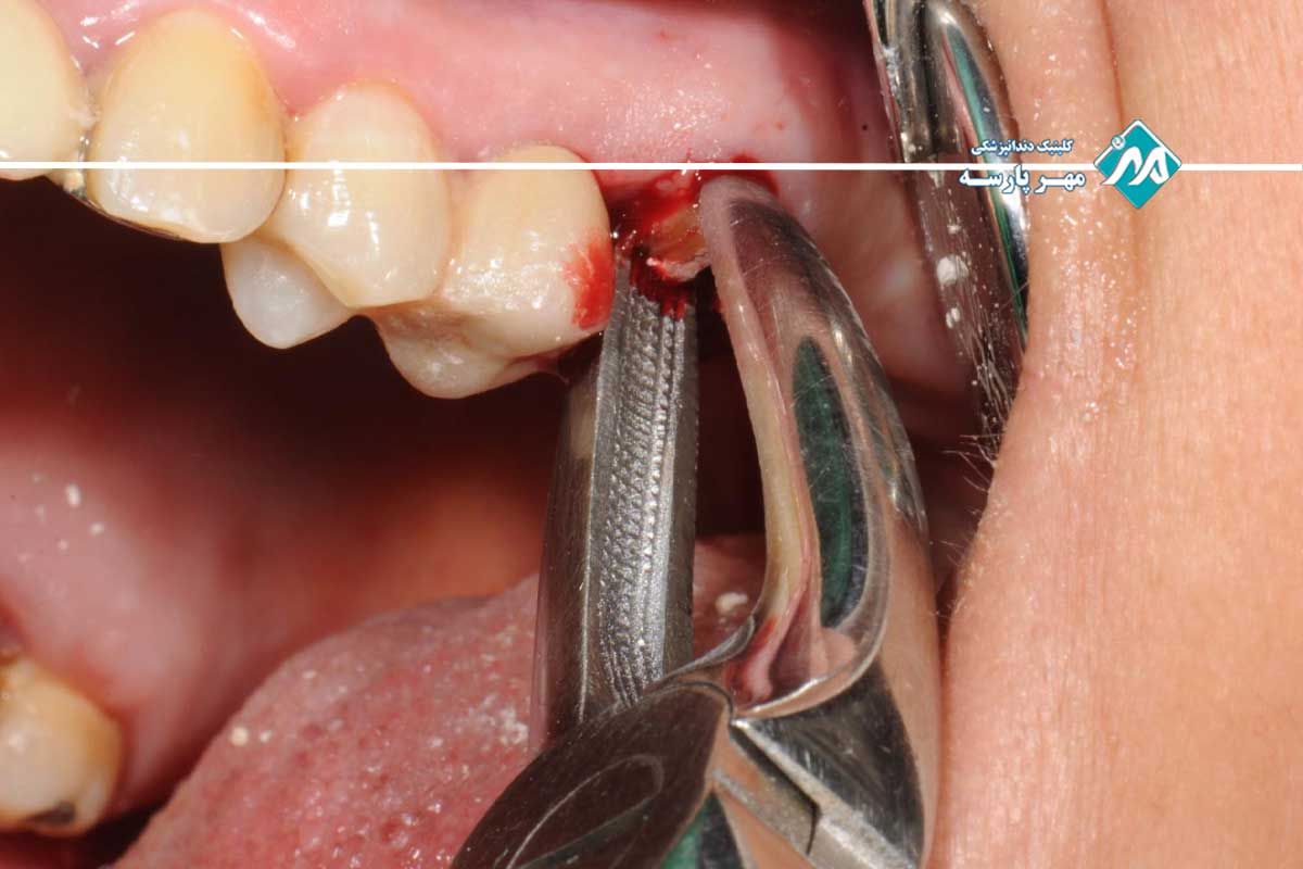 کشیدن دندان