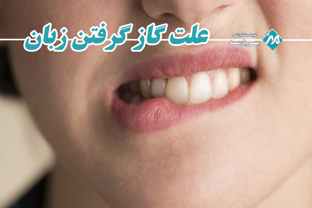 علت گاز گرفتن زبان هنگام غذا خوردن