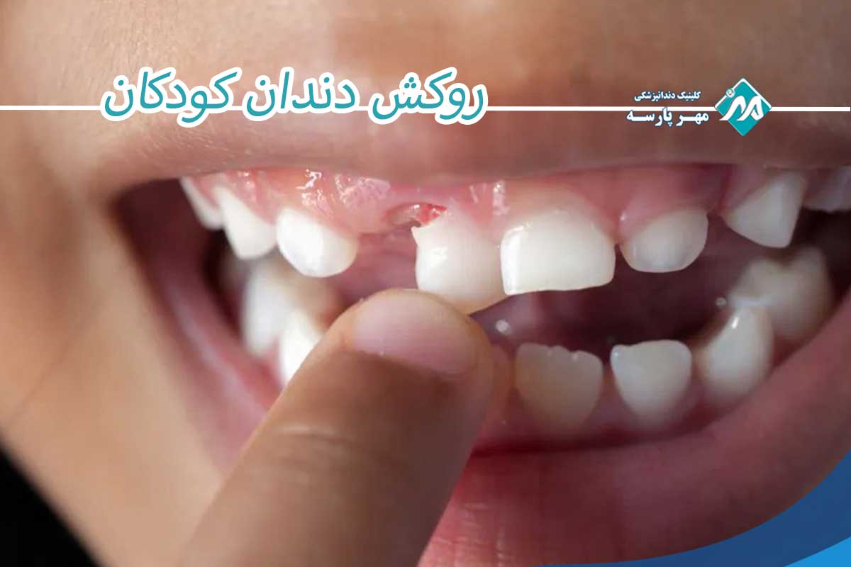 دلایل اصلی نیاز به روکش دندان اطفال چیست؟