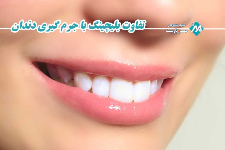 تفاوت بلیچینگ با جرم گیری دندان