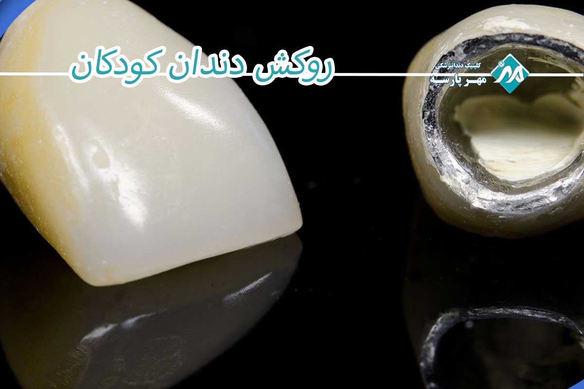 روکش دندان کودک