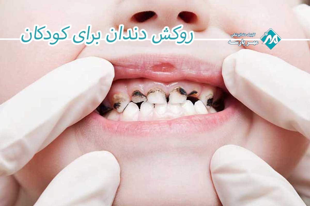 دلیل روکش دندان برای کودکان