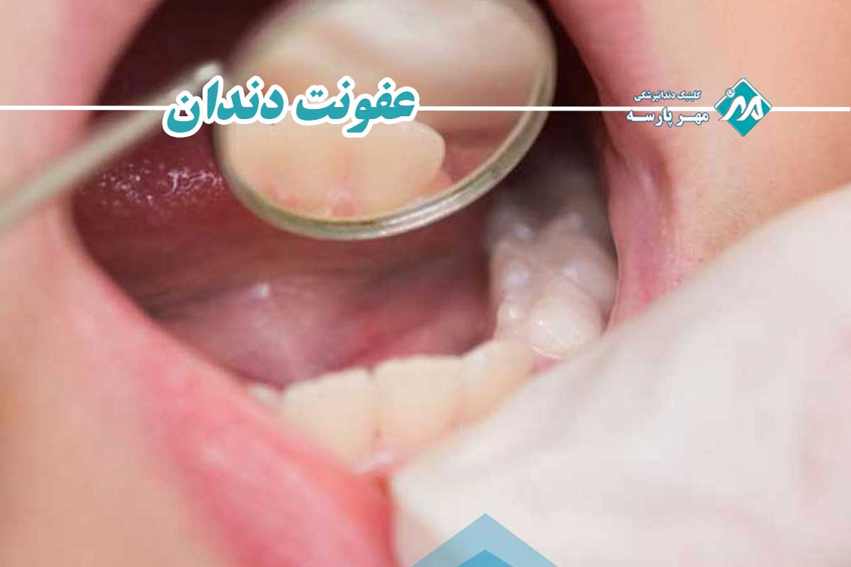 التهاب دندان