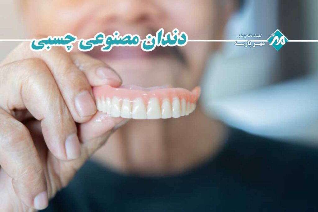 دندان مصنوعی چسبی