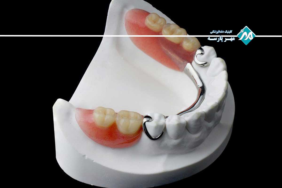 پروتز دندان پارسیل چیست و چه تفاوتی با دست دندان کامل دارد؟