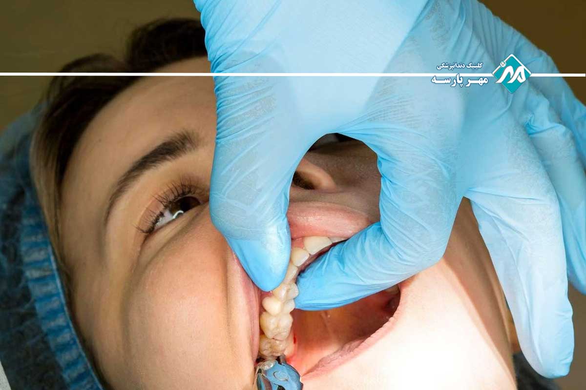 خطر تشکیل کیست و تومورهای فکی