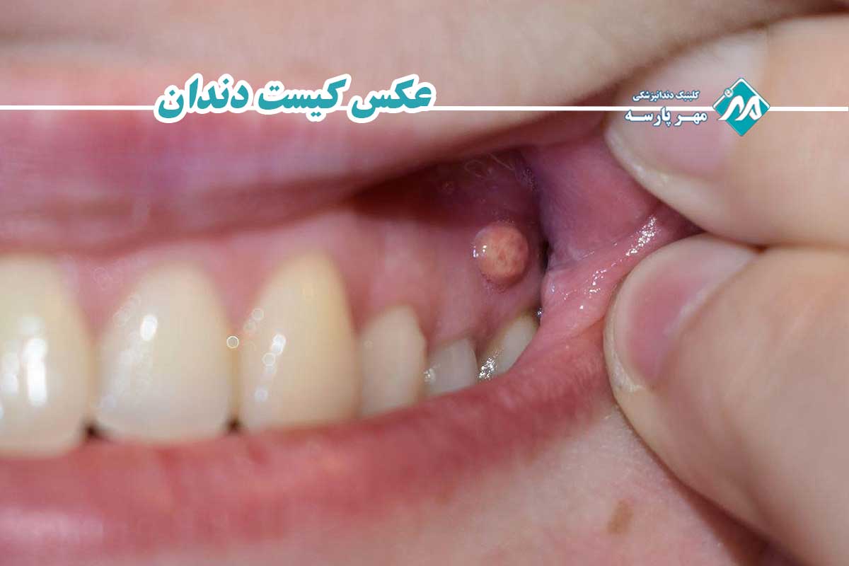 درمان قطعی کیست دندان در کلینیک چگونه انجام می‌شود؟