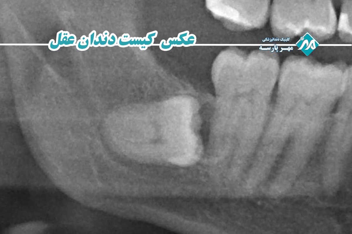 کیست دندان دقیقا چیست و چرا درمان خانگی آن را ریشه‌کن نمی‌کند؟