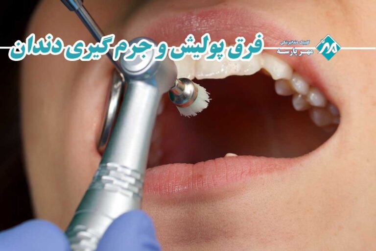 جرم گیری و پولیش دندان