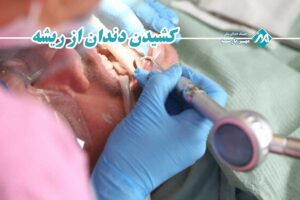 کشیدن دندان از ریشه