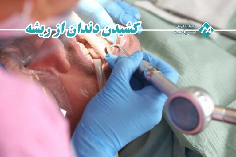 کشیدن دندان از ریشه