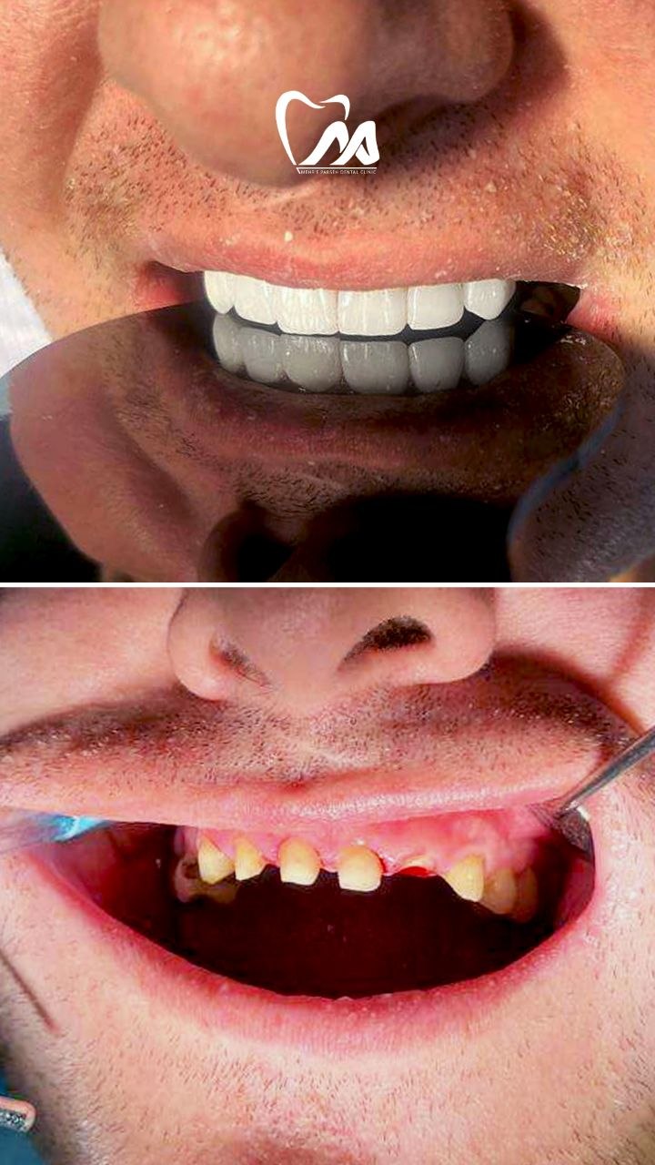 نصب ۸ واحد روکش تمام سرامیک زیرکونیا در کلینیک دندانپزشکی غرب تهران