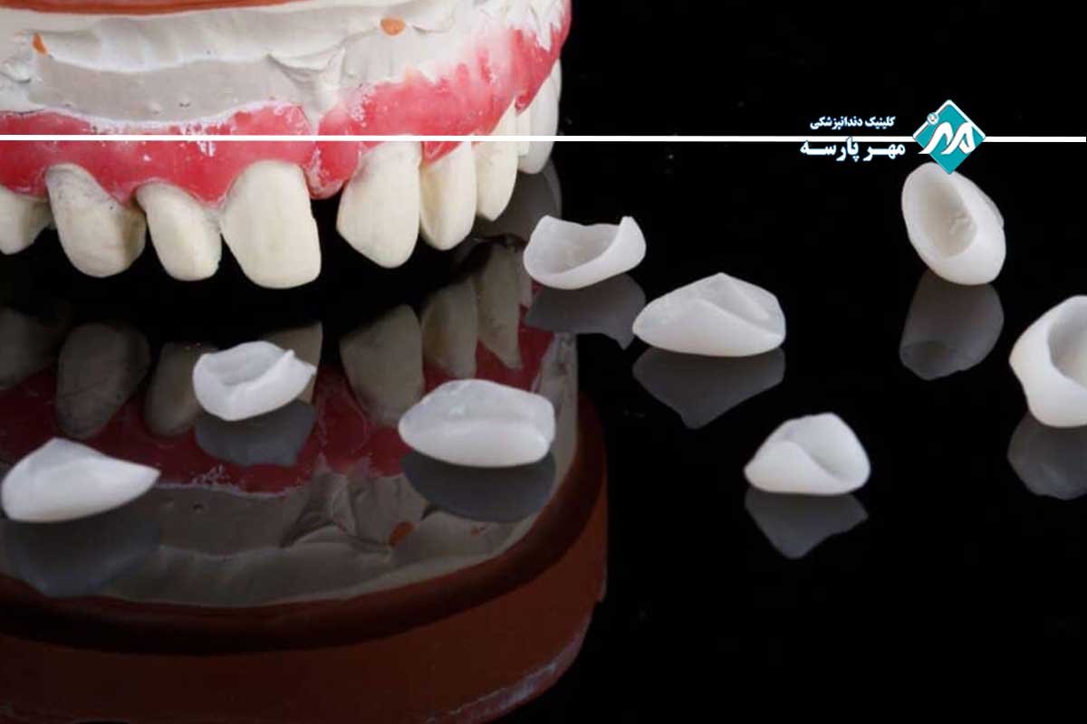 سرامیک‌های مورد استفاده در لمینت دندان بدون تراش