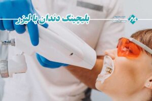 بلیچینگ دندان با لیزر