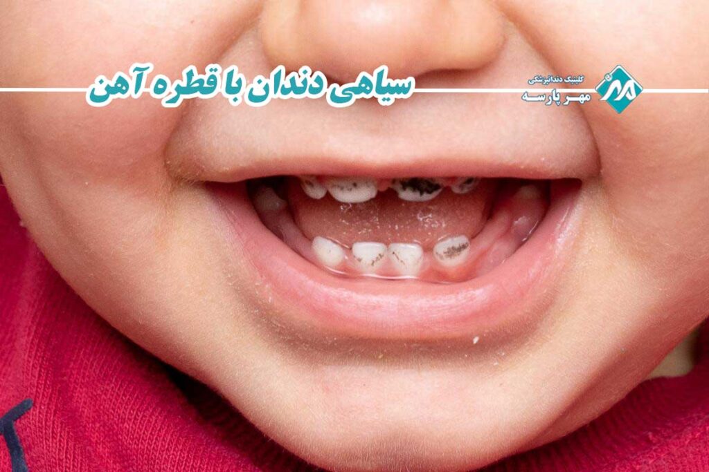 سیاهی دندان با قطره آهن