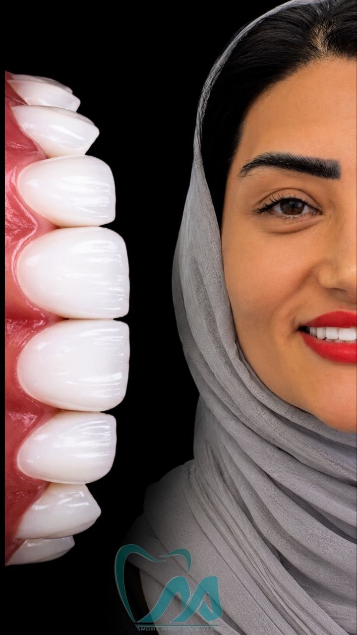 اجرای ونیر کامپوزیت زیبایی دندان در کلینیک مهرپارسه غرب تهران