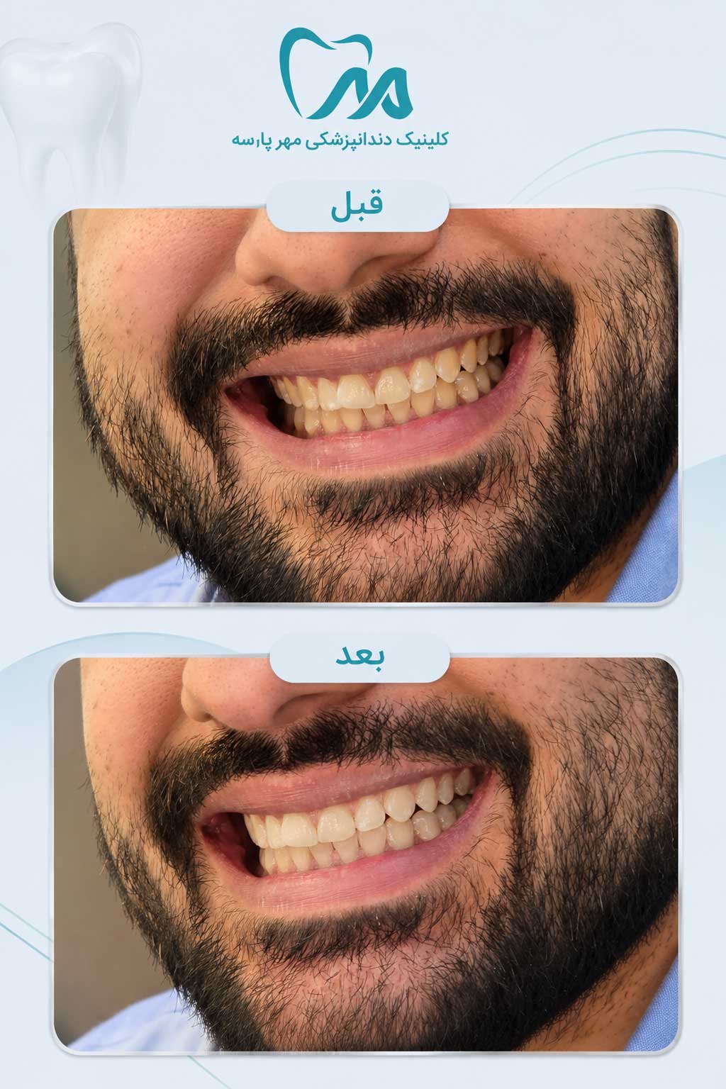 مقایسه قبل و بعد از سفید کردن و بلیچینگ دندان در غرب تهران