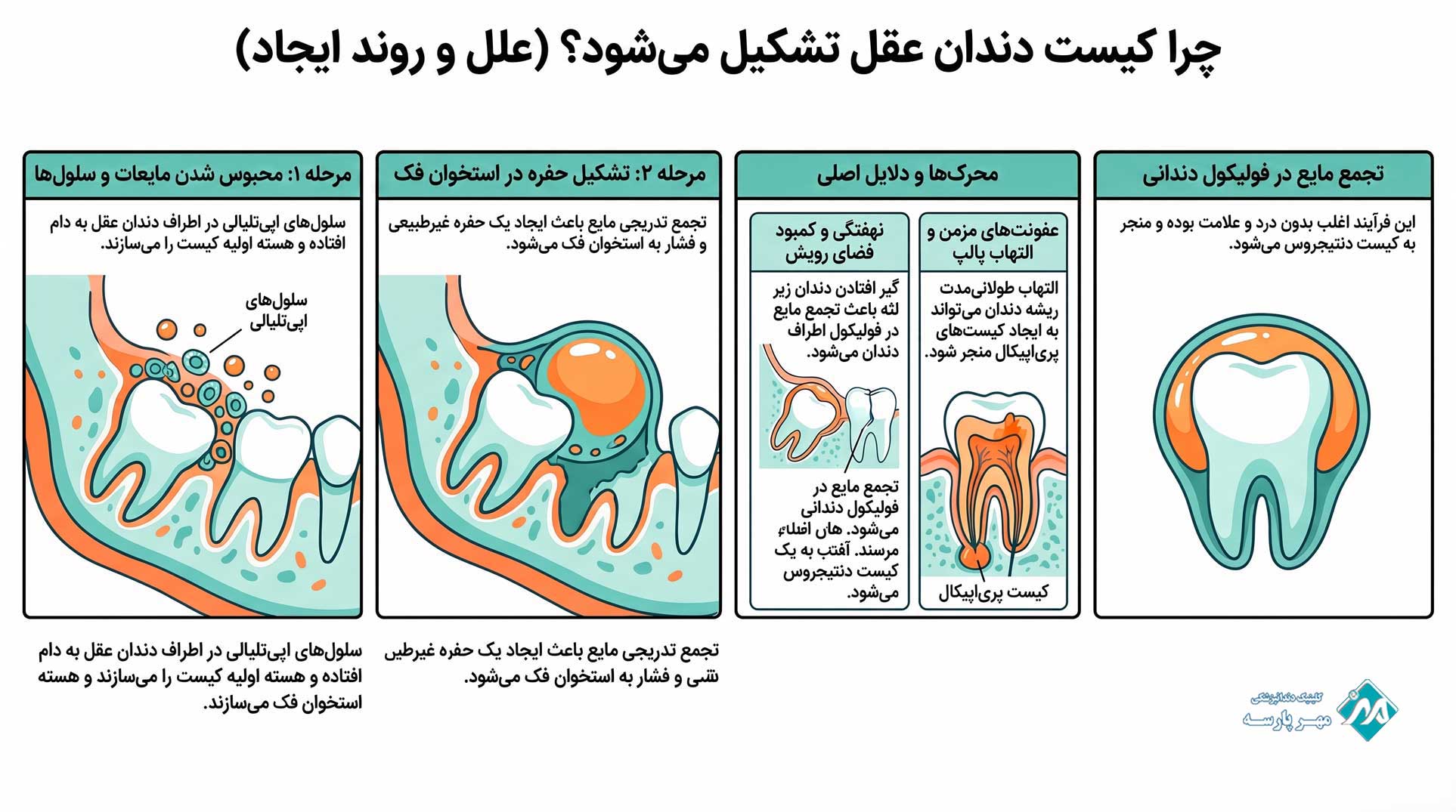 دلایل تشکیل کیست دندان عقل