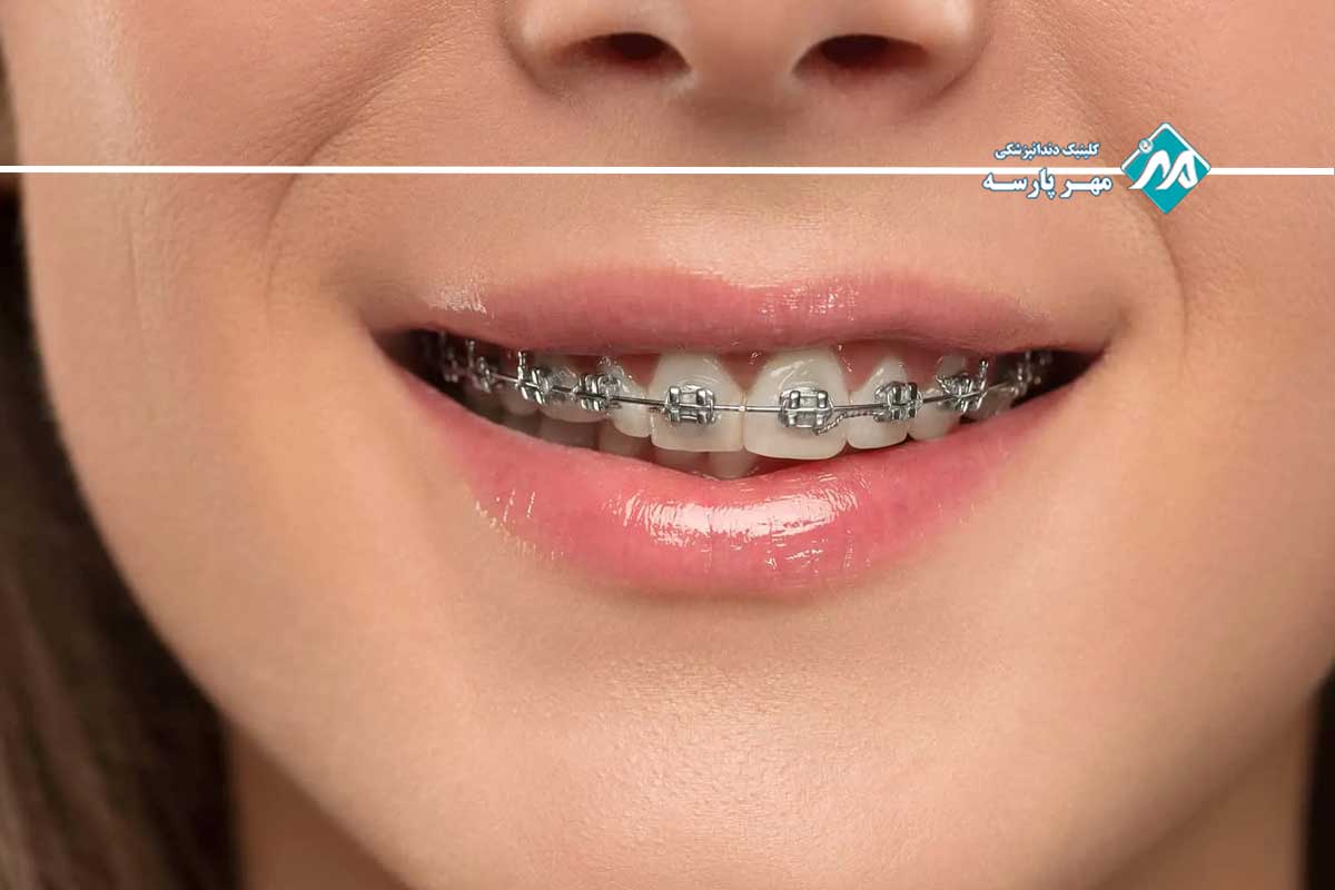 مقایسه ارتودنسی با سیم و ارتودنسی متحرک