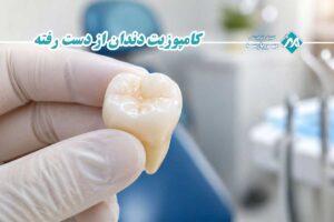 کامپوزیت دندان از دست رفته