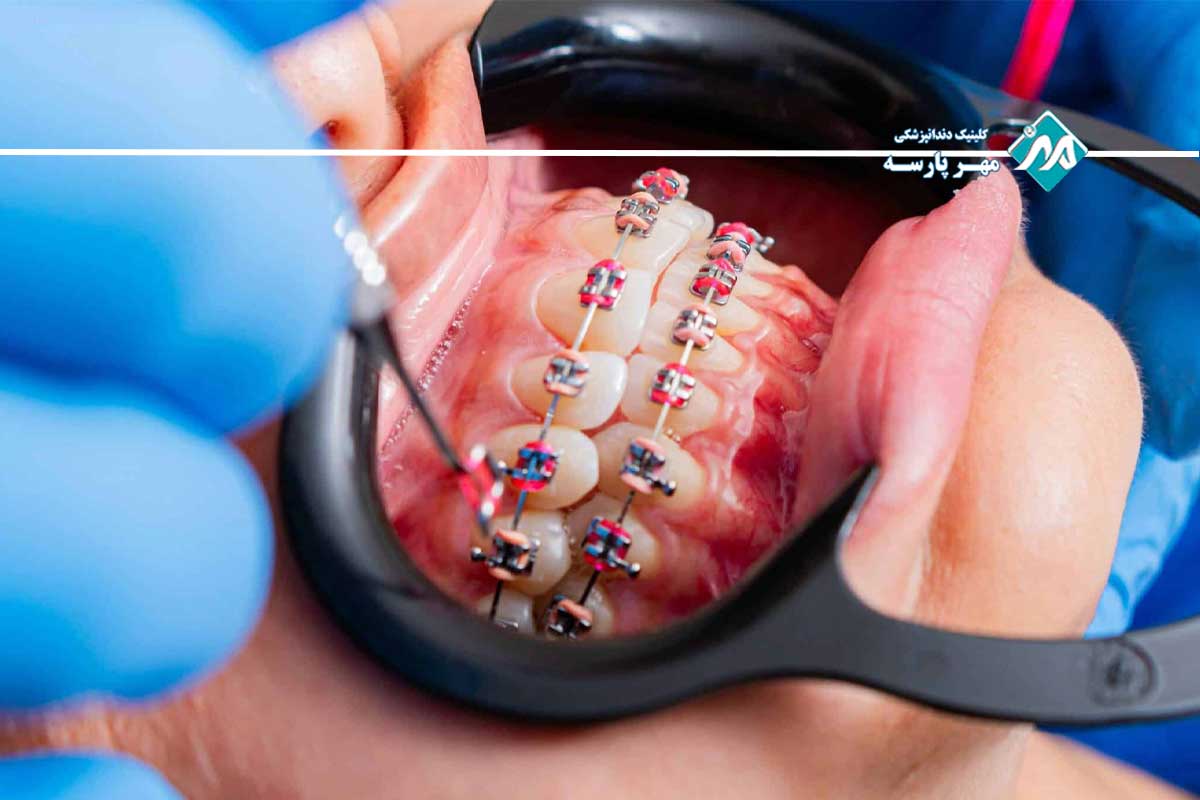 مراحل نصب ارتودنسی سیمی