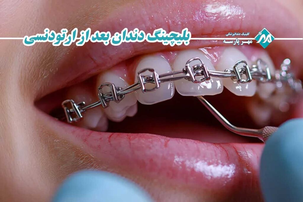 بلیچینگ دندان بعد از ارتودنسی