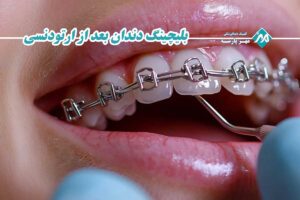 بلیچینگ دندان بعد از ارتودنسی