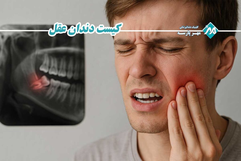 کیست دندان عقل