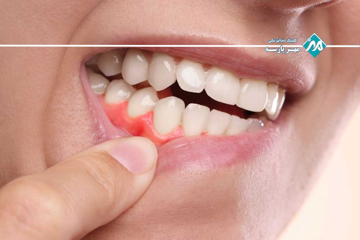 بیماریهای پیشرفته لثه