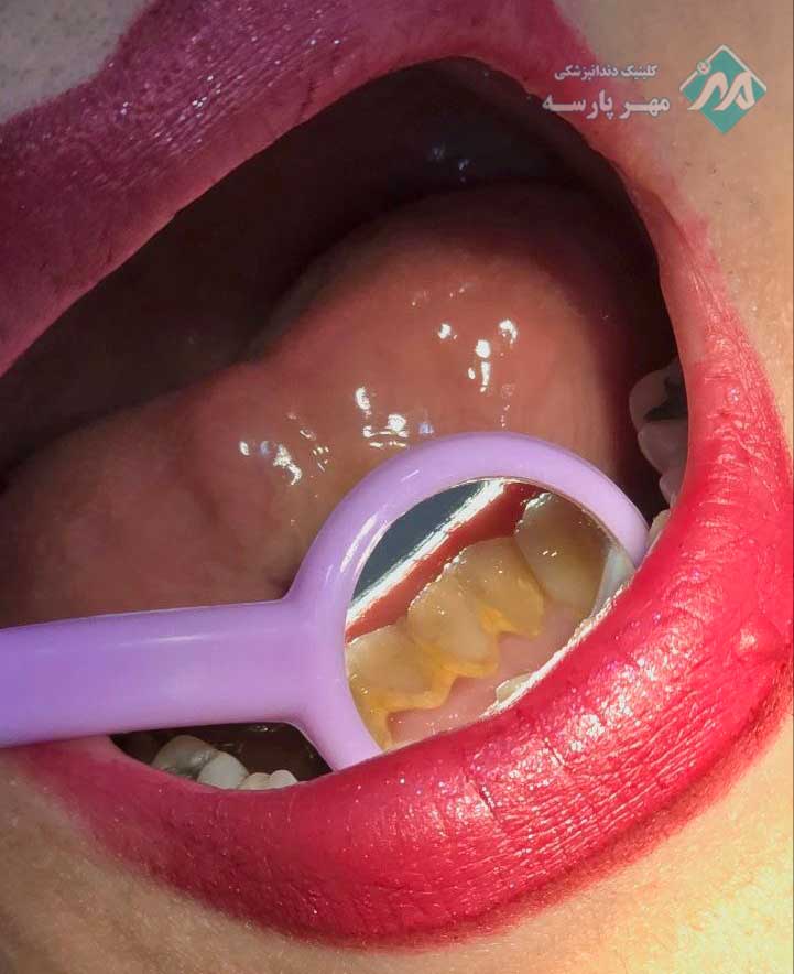 عکس قبل جرمگیری دندان در غرب تهران