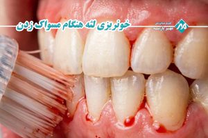 خونریزی لثه هنگام مسواک زدن