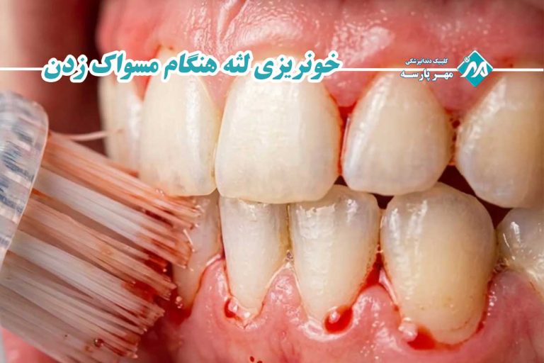 خونریزی لثه هنگام مسواک زدن