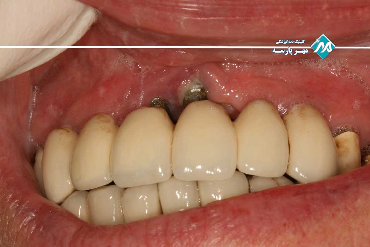 تفاوت پریایمپلنتایتیس با موکوزیت اطراف ایمپلنت