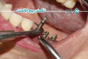 شکستن پیچ اباتمنت