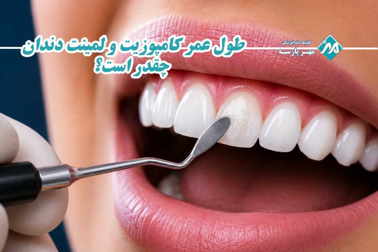 طول عمر کامپوزیت و لمینت دندان