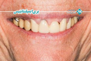 پریایمپلنتایتیس