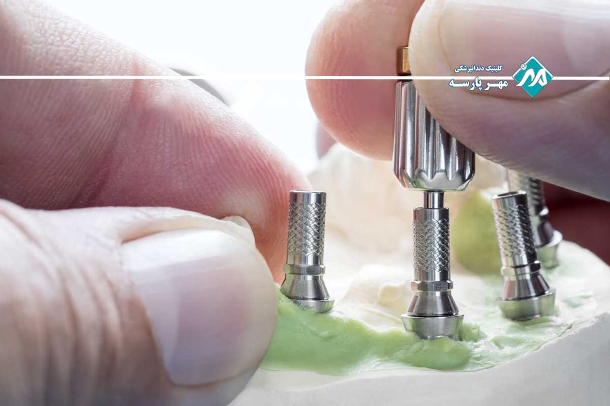 خارج کردن پیچ اباتمنت