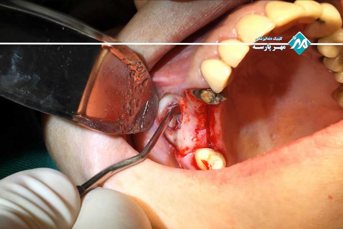 جراحی سینوس لیفت بسته