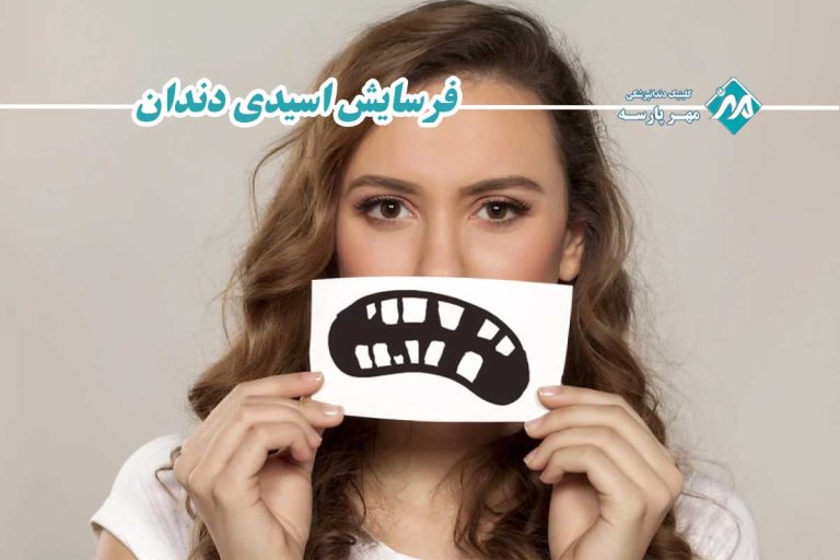 فرسایش اسیدی دندان