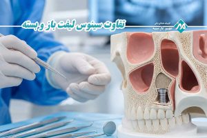 تفاوت سینوس لیفت باز و بسته
